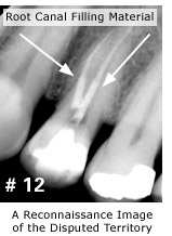 X-ray of the real tooth